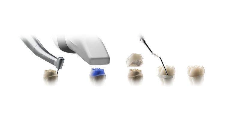 Tools and materials used in the digital with lab workflow, illustrating preparation and impression steps for single-unit crowns.