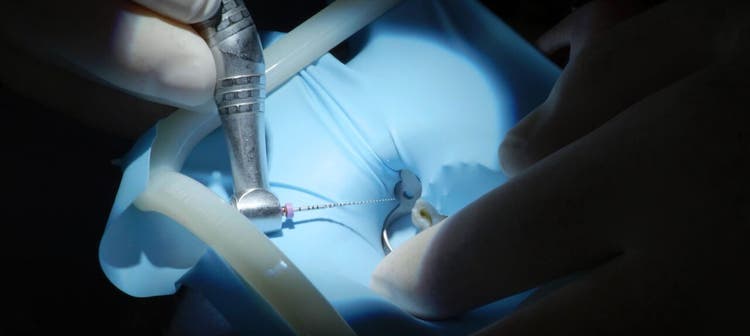 Gros plan sur la pièce à main dentaire utilisée lors d'un traitement endodontique